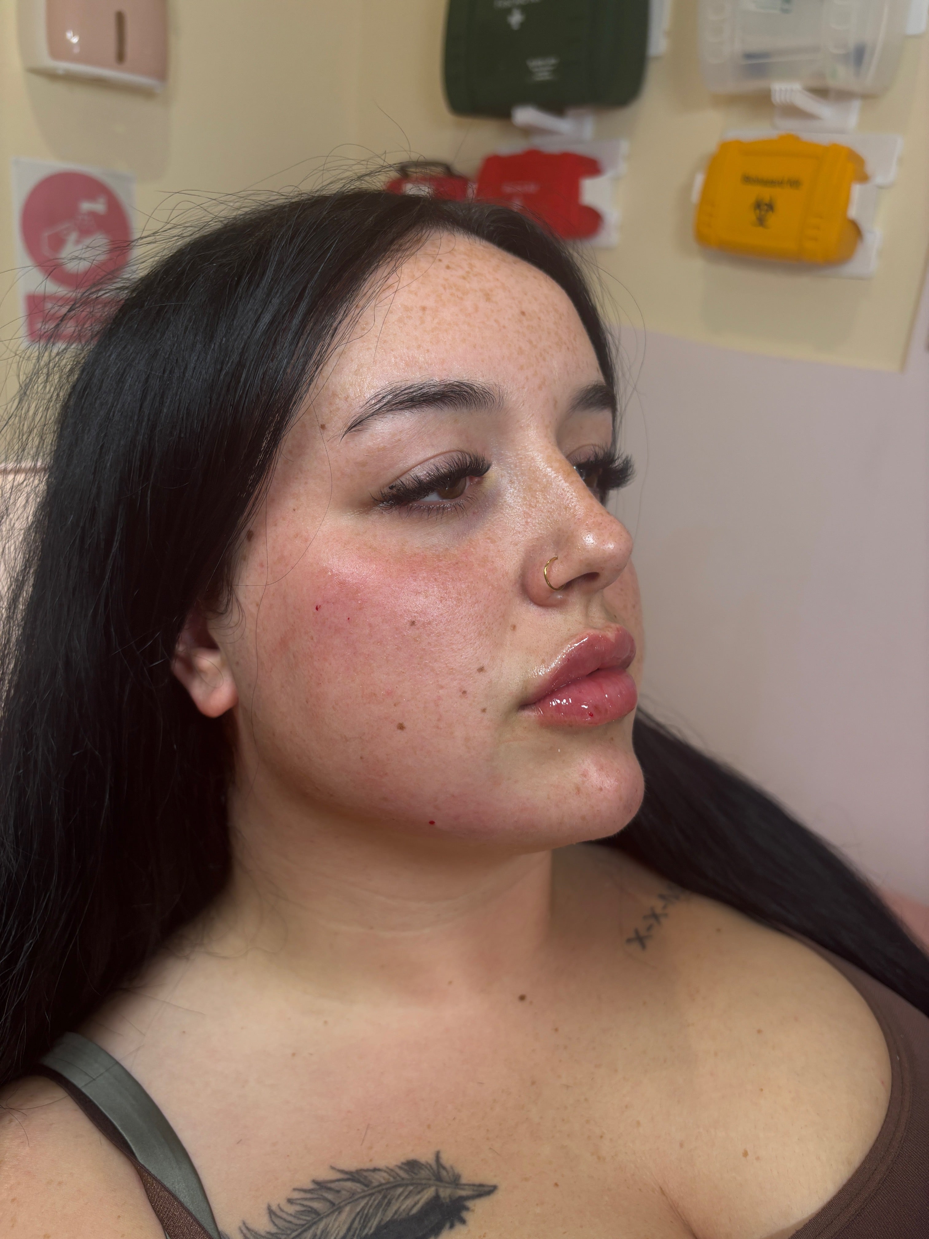 5ml dermal filler package