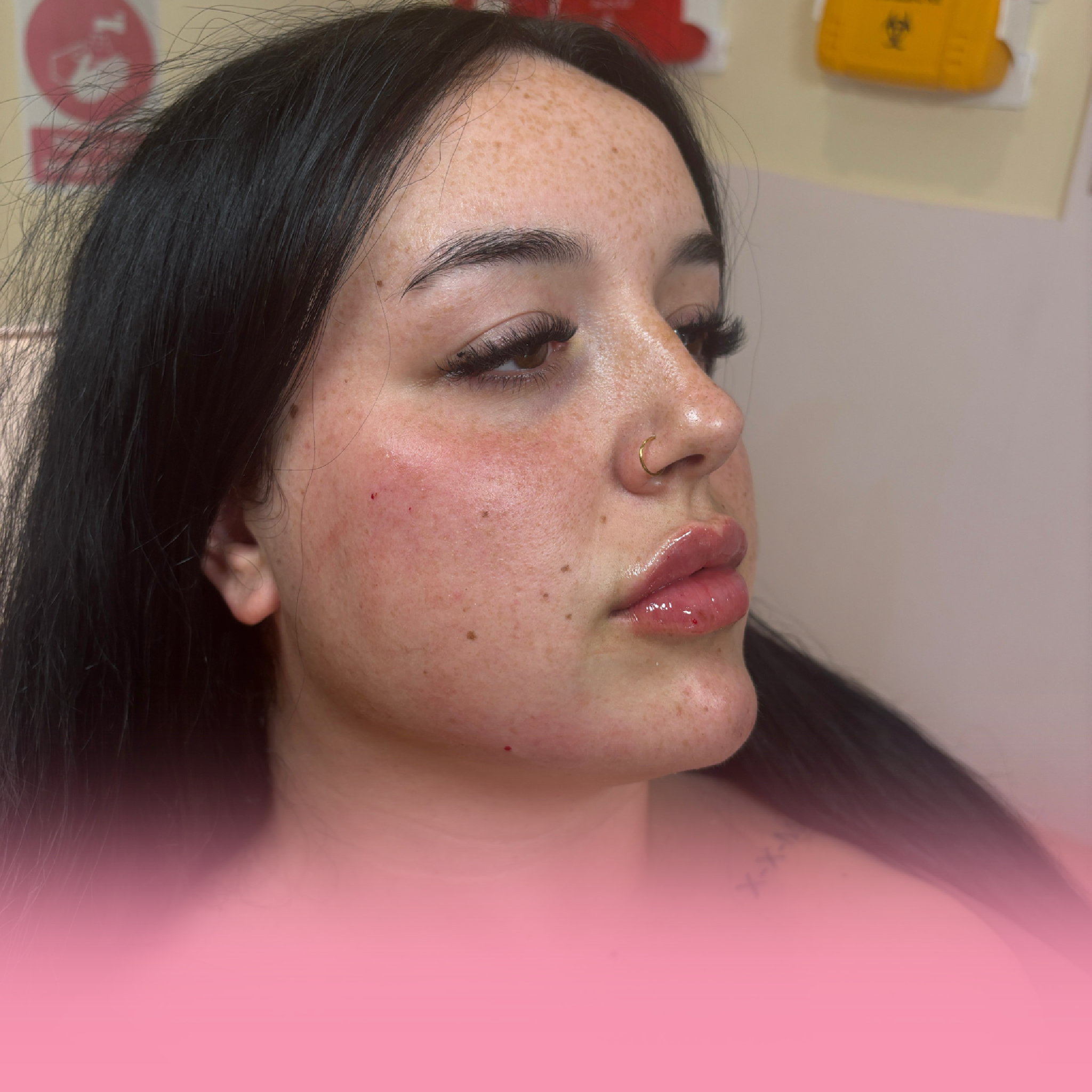 5ml dermal filler package